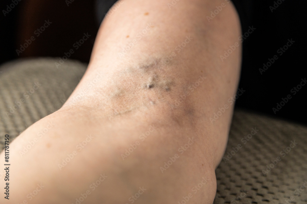 Caucasian woman have a varicose on inner side of arm Caucasian woman have a varicose on inner side of arm