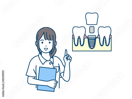 インプラントについて説明する歯医者、歯科衛生士の女性のイラスト