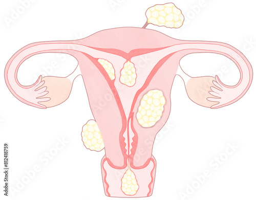 Blank uterine fibroids Unlabeled diagram Human anatomy transparent PNG