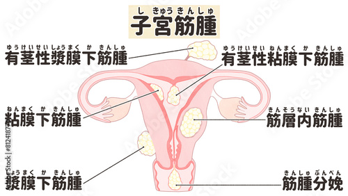 Types of uterine fibroids Labeled diagram Human anatomy PNG photo