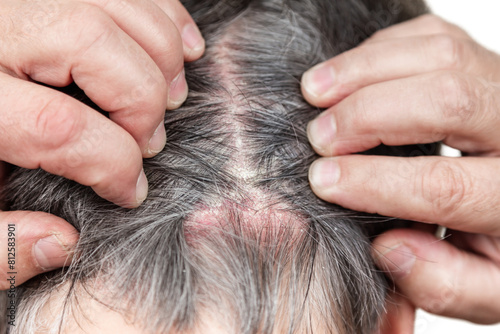 фотографія psoriasis