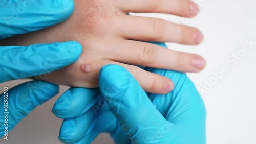 Dermatologist looks at child hand with viral flat warts, Verruca vulgaris, cure and treatment, close-up. Papillomavirus, HPV. Children dermatology, problems of skin diseases, one day surgery concept.  photo