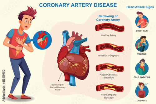 Coronary artery disease which Narrowing of heart arteries, restricting blood flow, leading to heart attacks and chest pain, Which increases risk of heart attack.  photo