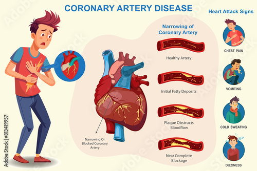 In Coronary artery disease, Heart arteries become narrow, which may causing chest pain and heart attacks photo