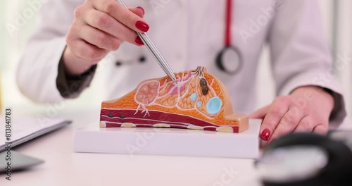 Female doctor explains the disease using an anatomical model of breast. Diagnosis of mammological diseases photo