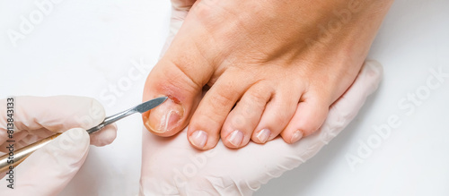 Pedicure, podologist. Patient on medical pedicure procedure, nail disease, cholesis detachment of the nail plate. Foot care, treatment in a medical spa salon. photo