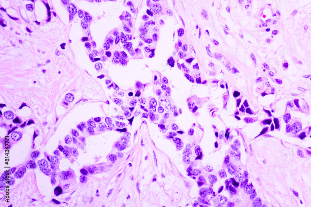 Backgrounds of human cells tissue of cervix under the microscope in pathology lab.View in microscopic of ductal cell carcinoma, adenonocarcinoma from human breast cancer, tissue section by H and E