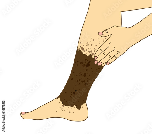 Varicose chronic or blood clot on calf leg syndrome, diabetes disease, illustration on white background