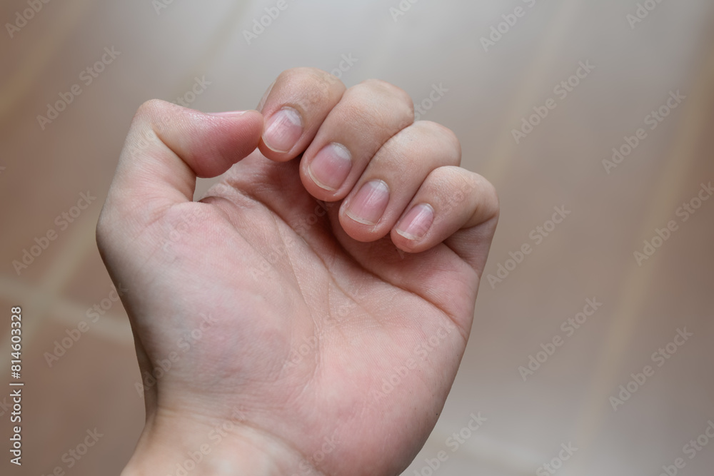 Hands clenched into fists show fingernails and the texture of the hands indicates health problems with the skin.