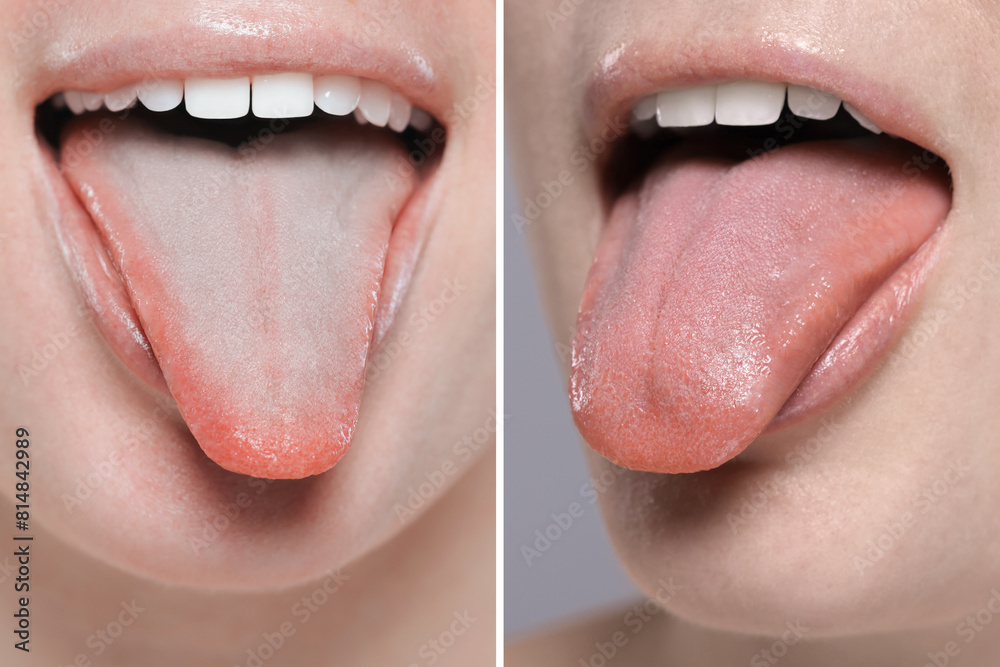 Obraz premium Woman showing her tongue before and after cleaning procedure, closeup. Tongue coated with plaque on one side and healthy on other, collage