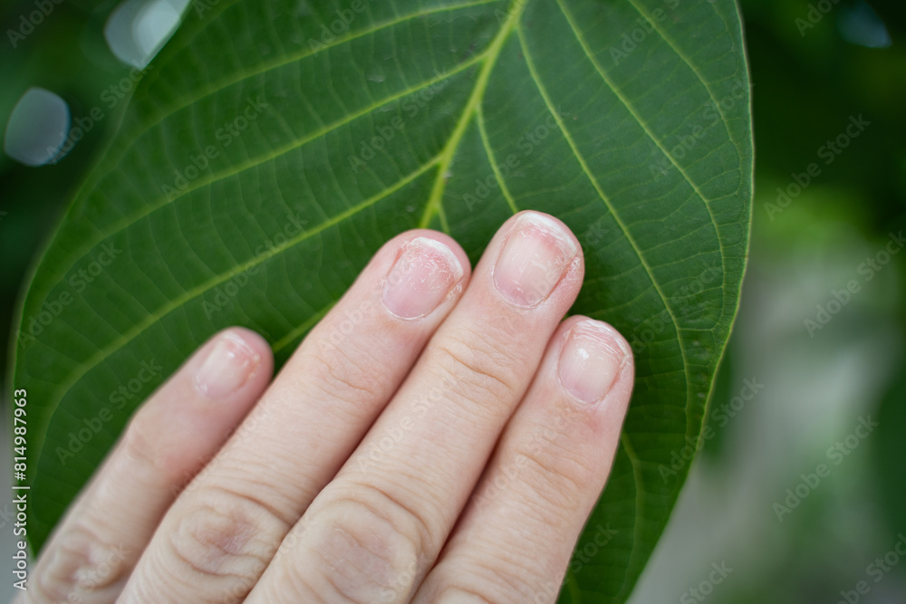 Regrown nail cuticle and damaged nail plate after gel polish. Flaky brittle nails without a manicure.