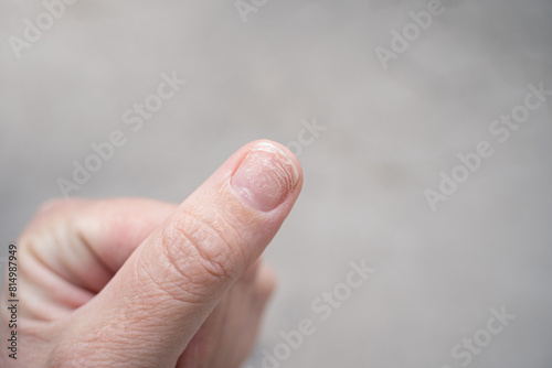 фотографія Regrown nail cuticle and damaged nail plate after gel polish