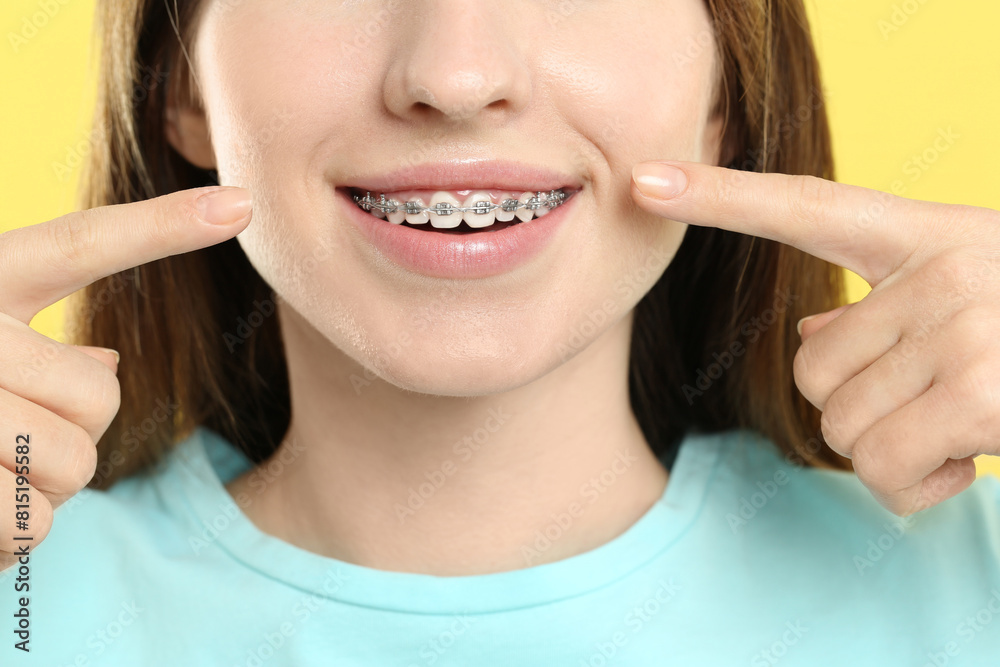 Smiling woman pointing at her dental braces on yellow background, closeup Smiling woman pointing at her dental braces on yellow background, closeup