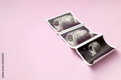Ultrasound Image, Picture Of 7 Weeks Pregnant Woman With Twins, Embryo On Pink Background. Selective Focus. Space For Text, Mockup. Fetus Development, Pregnancy Health Checking. Maternity, Horizontal