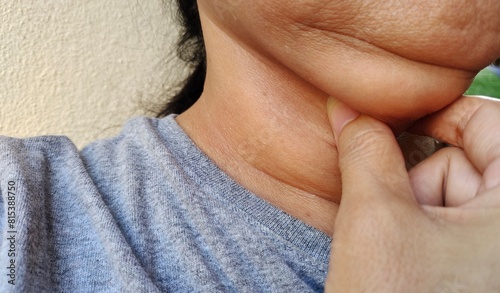 close up the fingers holding the flabbiness adipose sagging skin under the chin, neck wattle and cellulite, Flabby skin and loose under the neck of the woman, health care and beauty concept. photo