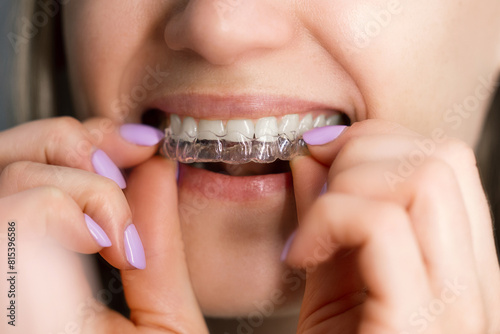 woman inserting transparent invisible dental aligners for teeth straightening