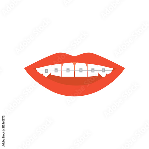 Smile with white teeth and orthodontic braces.