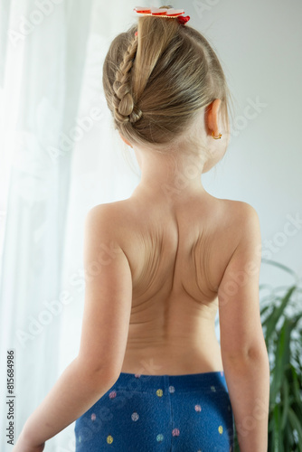 back little girl  child 5 years old sore spot  curved spine  pain in spine  therapeutic massage for osteochondrosis  Scoliosis in children  intervertebral hernia