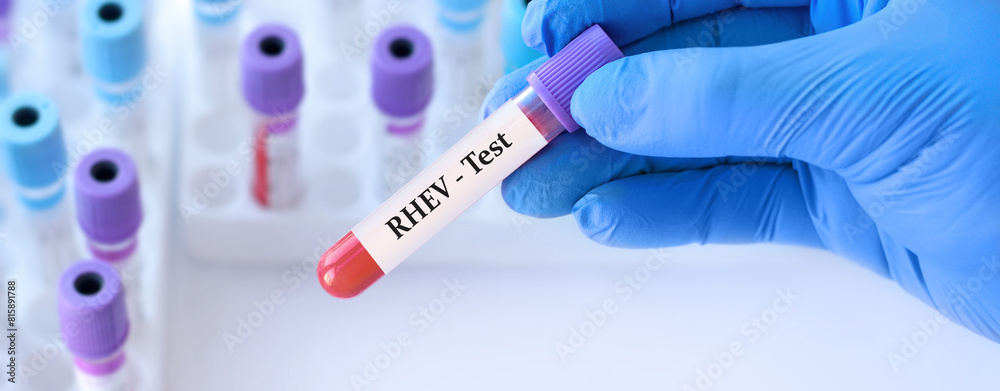 Naklejka premium Doctor holding a test blood sample tube with Rocahepevirus, ratti, (RHEV) virus test on the background of medical test tubes. Cases of human infection with rat hepatitis E have been reported in Spain.