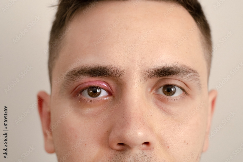 A close-up of a man's red and swollen eye, highlighting products for treating conjunctivitis and other eye infections, emphasizing their effectiveness and quick symptom relief.