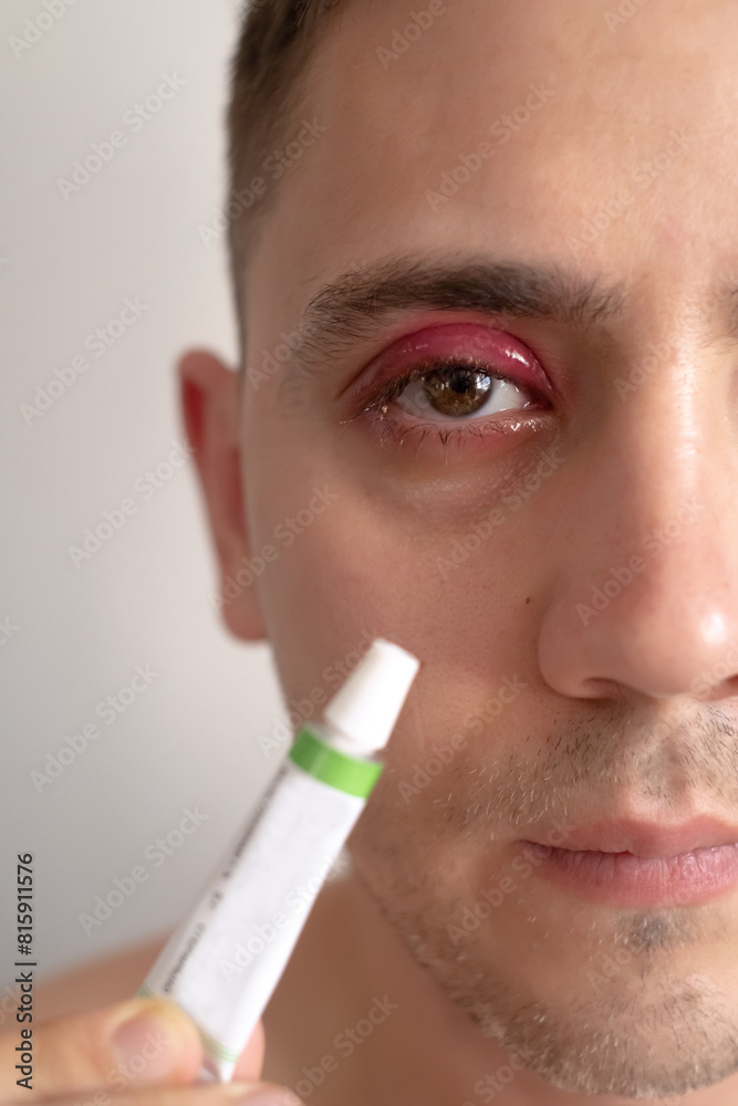 A close-up of a swollen and reddened eye of a man, highlighting the importance of seeking consultation and treatment for eye infections. Emphasize the importance of consulting A close-up of a swollen and reddened eye of a man, highlighting the importance of seeking consultation and treatment for eye infections. Emphasize the importance of consulting
