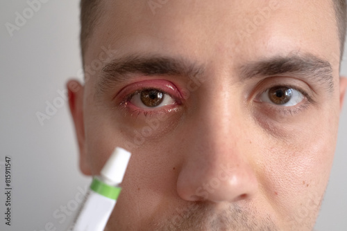 A portrait of a man suffering from an eye infection. Highlighting everyday eye care products that can help prevent infections, such as eye drops, rinsing solutions, or specialized hygiene products. photo