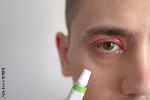 A close-up of a man's eye affected by conjunctivitis, showcasing an eye infection in a human body part. The man holds ointment for treating conjunctivitis.