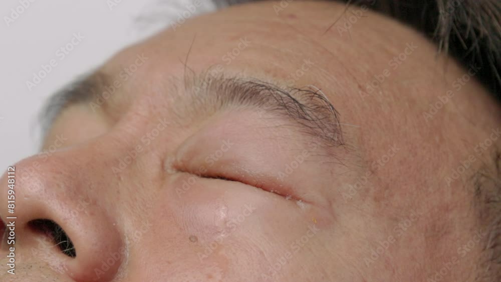 Senior man use antibiotic eye drops to treat swollen eye from insect