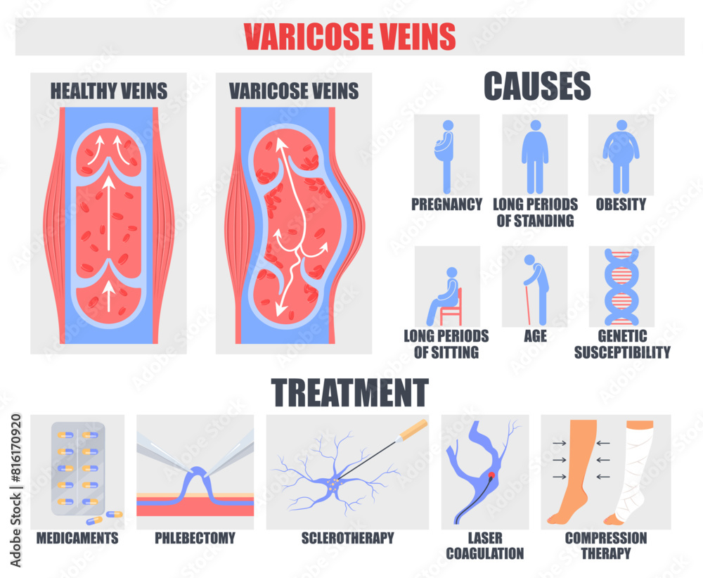 Zb Method Varicose vein disease causes and treatment methods medical poster ...