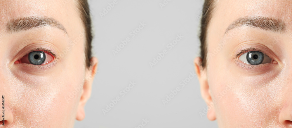 Before and after conjunctivitis treatment. Photos of woman with red and healthy eyes, collage Before and after conjunctivitis treatment. Photos of woman with red and healthy eyes, collage