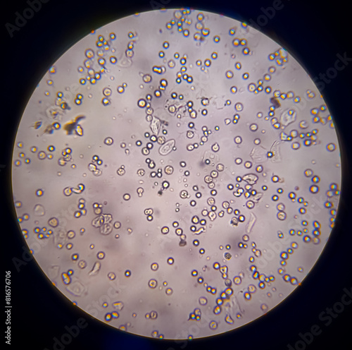 Pyuria or leukocyturia is the condition of urine containing white blood cells or pus. It can be a sign of a bacterial urinary tract infection.Micrograph photo