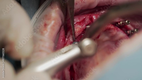 Installation of a bridge prosthesis.