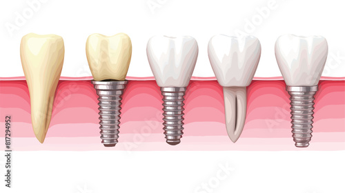 Stages of dental implant installation. Steps for pl