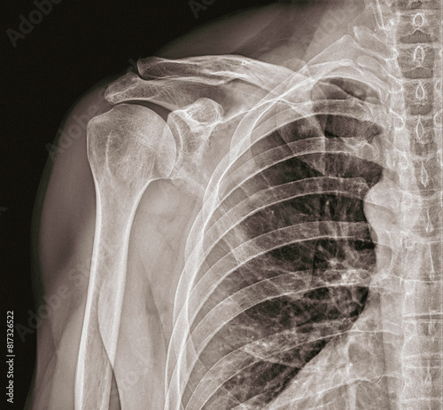 X ray radiograph right shoulder with many broken ribs and shoulder dislocation rib cage