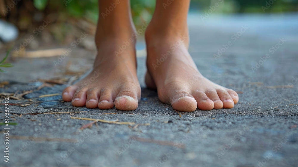 Flat feet occur when the arch of the foot collapses, causing the entire