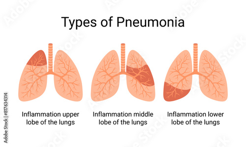 Types of pneumonia diseases