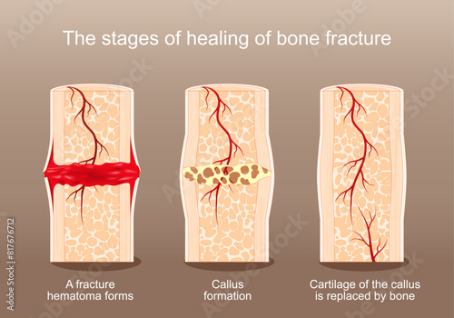 Healing of bone fracture. photo
