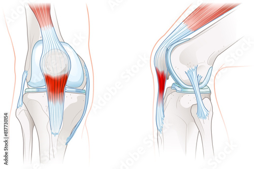 Patellar tendonitis. Jumper's knee. Illustration