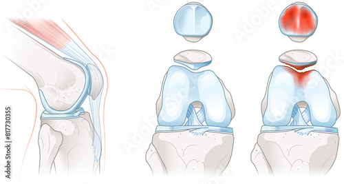 Chondromalacia patella. Knee pain. Runner’s knee.