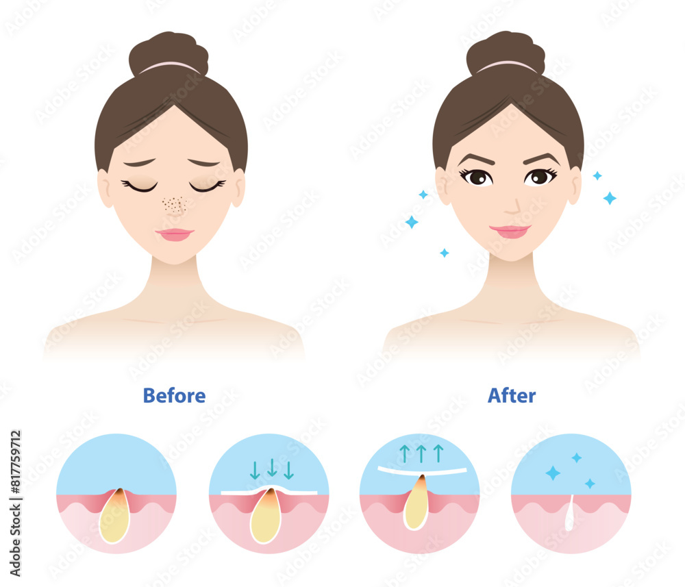 Comparison of woman face before and after blackhead removal vector illustration isolated on white background. Icon set of blackhead treatment process, apply, peel off, unclogging and tighten pore. Comparison of woman face before and after blackhead removal vector illustration isolated on white background. Icon set of blackhead treatment process, apply, peel off, unclogging and tighten pore.