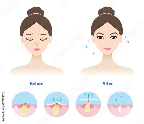 Comparison of woman face before and after blackhead removal vector illustration isolated on white background. Icon set of blackhead treatment process, apply, peel off, unclogging and tighten pore.