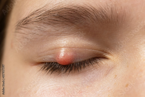 Chalazion on the eyelid of girl macro. Demodicosis mite diseas, demodex. Eye of girl with stye close-up. photo