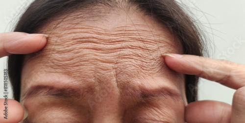 Woman with headache, stress and serious, worried and angry, forehead lines and wrinkles, health care and medical concept. photo