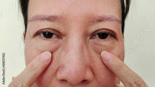portrait the fingers holding the flabbiness adipose sagging skin, swelling and ptosis, cellulite and bag under the eyes, dark spots and blemish on the face, health care and beauty concept.