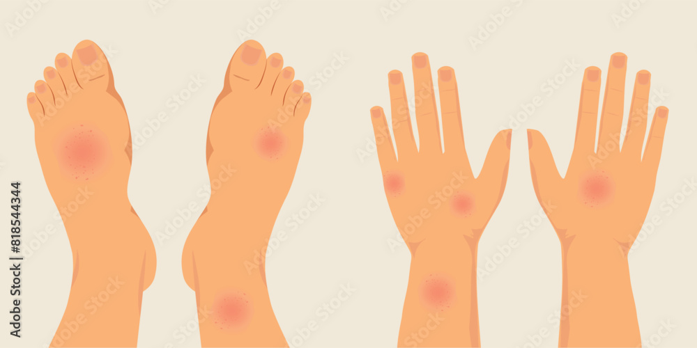 Human legs and hands covered with red rash. Human legs and hands covered with red rash.