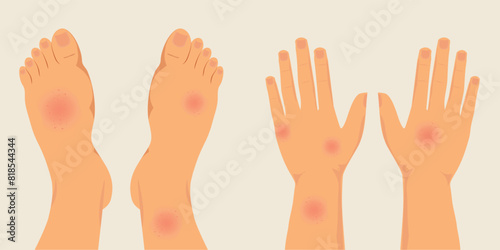 Human legs and hands covered with red rash.