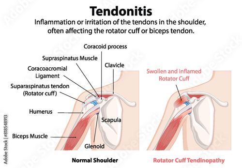 Inflammation of shoulder tendons, rotator cuff photo