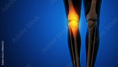 Human knee joint and bones with inflammation