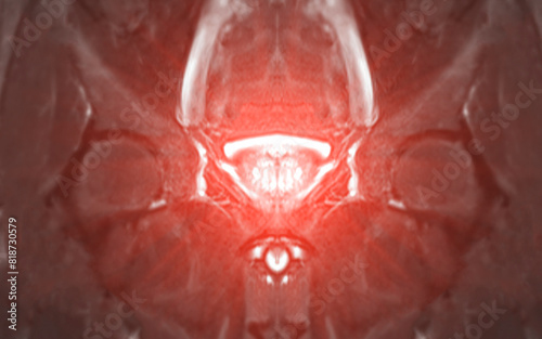 MRI of the prostate gland, revealing an enlarged size.