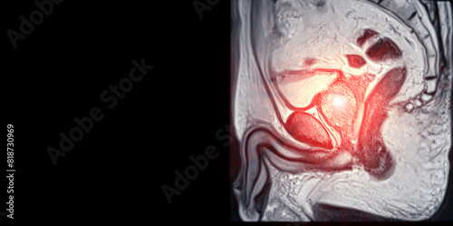 MRI of the prostate gland, revealing an enlarged size.